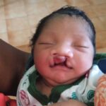 जब चिरायु टीम बनी एक परिवार की उम्मीद, जन्मजात विकृति से जूझ रहे बच्चे को मिला नया जीवन