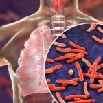 चंडीगढ़ में बढ़े टीबी के मरीज, हर दिन 18 नए मामले, 6000 से अधिक लोग प्रभावित